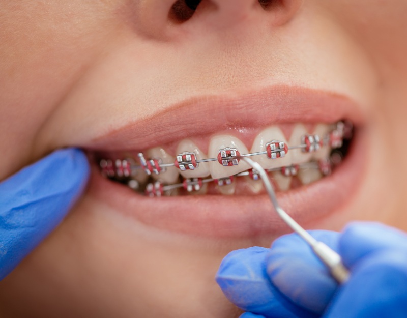 Behel gigi - Dela Dental Care