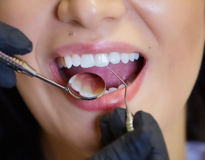 Perawatan gigi lainnya - Dela Dental Care