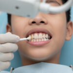 pengolesan vitamin gigi Dela Dental Care