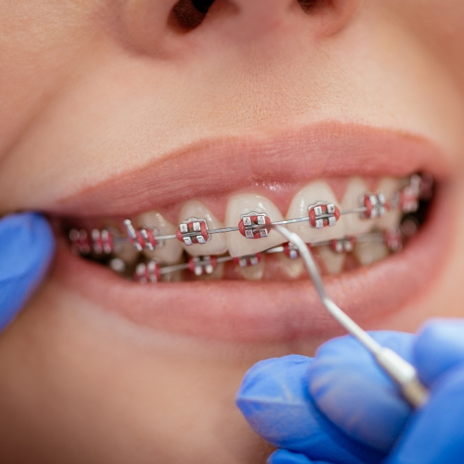 Diskon behel gigi dela dental care sidoarjo